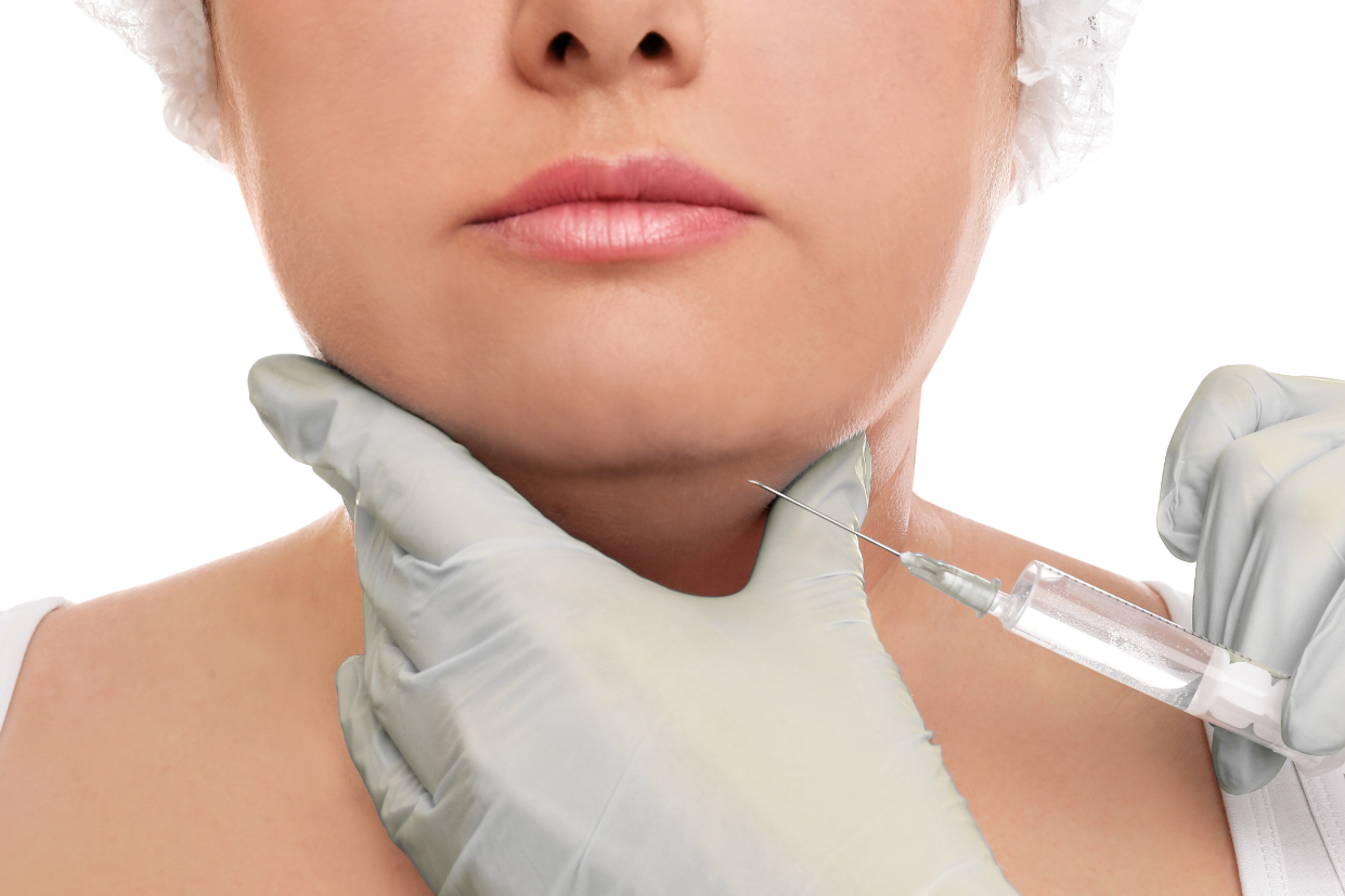 Fett-weg-Spritze Doppelkinn Fett-weg-Spritze, die an das Kinn einer Person verabreicht um das Doppelkinn zu minimieren